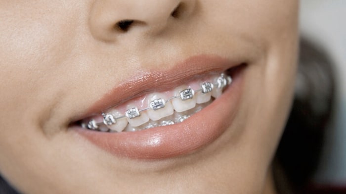 La phobie du dentiste chez les adolescents