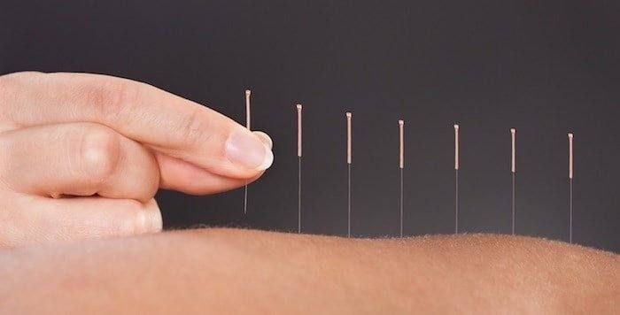 acupuncture-definition-efficacite.jpg